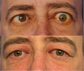 Before & After Orbital Surgery Gallery